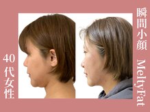 即効性抜群の小顔メニュー