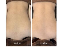 ビビ(VIVI)/背中の毛孔性苔癬にお悩みの方