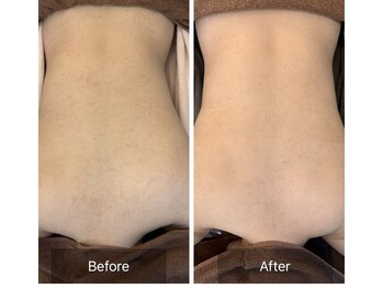 ビビ(VIVI)/背中の毛孔性苔癬にお悩みの方