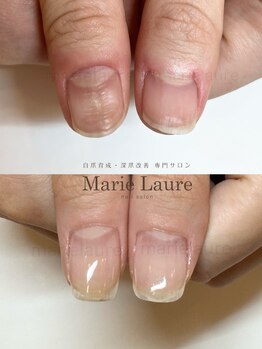 マリーロール 梅田店(Marie Laure)/深爪矯正/自爪育成/自爪風