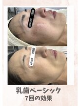 リンフェイス 浦安店(RINFACE)/エイジングケアにもオススメ！