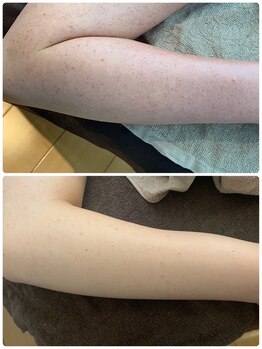 ルアナアイナ(Luana Aina)/二の腕ケア/ハーブピーリング