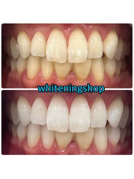 ホワイトニングショップ 大阪玉造店/Before&After美白ホワイトニング