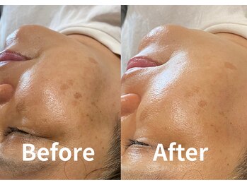 デン(DEN)/プラズマニア【1回でこの効果】