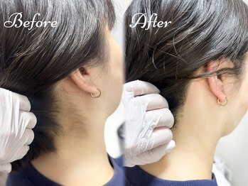 ピミル(PIMIL)/うなじ脱毛