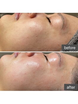 ロッタ エクリュ(Lotta ecru+)/REVI剥けないハーブピーリング