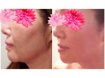 レムロード 川口店/モンテリフトUP2ヶ月後の結果