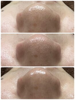 サロン ラズリ 久留米店(SALON Lazuli)/【毛穴洗浄】角質・角栓を改善