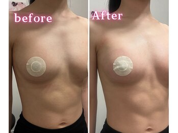 ジュエルリング(Jewel Ring)/症例写真バストアップ