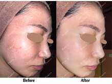 ピュアラ梅田/白玉ホワイトスノーピールで光肌