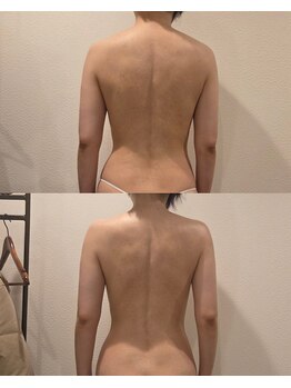 トータルエステティック ジョワイユ(JOYEUX)/背中ケア