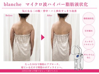 オリエンタルローザ 表参道(Oriental Rosa)/マイクロ波ハイパー脂肪液化術！
