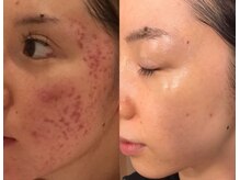 じぶんdeエステ 梅田店/ビフォーアフター1