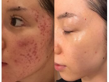 じぶんdeエステ 梅田店/ビフォーアフター1