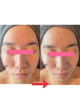 ダリア(Dahlia)/ハーブピーリング