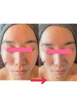 ダリア(Dahlia)/ハーブピーリング