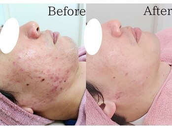 ユニクリア(Uni clear)/佐賀市│ニキビケア