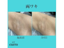 アクト クロ(ACT curro)/【両ワキ】脱毛施術例
