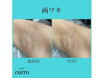 アクト クロ(ACT curro)/【両ワキ】脱毛施術例