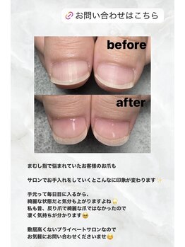 ココ(COCO)/まむし爪知ってますか?