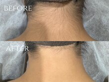 ウード(oud.)/うなじ脱毛