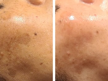 ブラン(BLANC)/<一番人気>新水光ピール