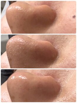 サロン ラズリ 久留米店(SALON Lazuli)/【毛穴洗浄】つるすべ肌へ♪