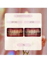 プラスビー 2号店(+b)/ホワイトニングビフォーアフター