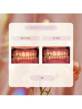 プラスビー 2号店(+b)/ホワイトニングビフォーアフター