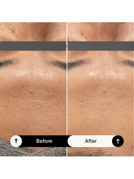 ホイップスパ(WHIP SPA)/毛穴洗浄【1度の効果】