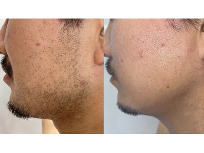 アッシュボウプラス(H.beau+)の写真