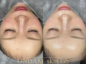オンダム 表参道(ONDAM)/赤ら顔でお悩みの方にも◎