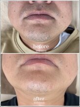 モット いこらもーる泉佐野店(mot)/口下・あご下脱毛