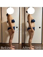 ニュアージュ(Nuage)/40代女性　施術５回の変化