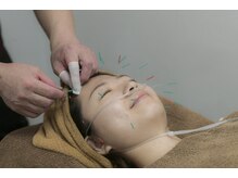 中島整骨院 鍼灸院 整体院/美容鍼と水素吸引です