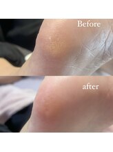 メリーミー(Merry me)/魚の目ケア　ご相談下さい★