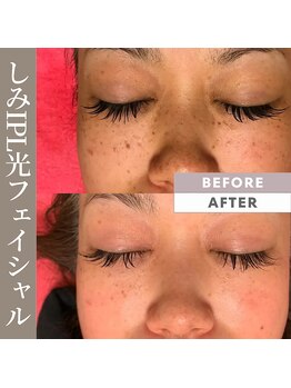 メロウ(mellow)/しみにIPL光フェイシャル☆