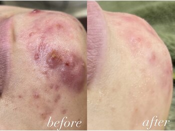 レシェルサロン(Lechelle Salon)/ハーブピーリング+ダーマエステ