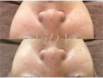 ヴィーダ 渋谷松濤(ViDA)/REVIメンズハーブピーリング