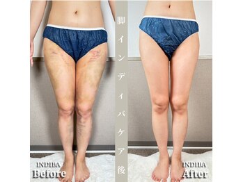 術後の女神 大阪本町店/ダウンタイムケア・インディバ