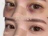 《　FACIAL　》目周りDT特化！埋没・クマ・切り/インディバケア60分¥12,800