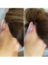 インベスト(INVEST)/うなじ脱毛