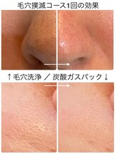 ラ ルミエール(La Lumiere)/"毛穴コース"一回でスッキリ！