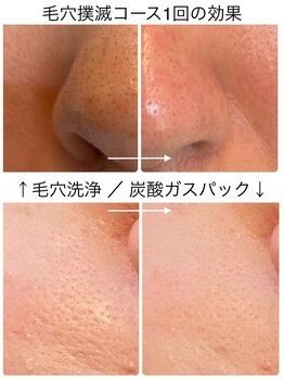 ラ ルミエール(La Lumiere)/"毛穴コース"一回でスッキリ！