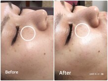 ラウレア(LAULEA)/シミ改善Before/after(1ヶ月)