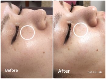 ラウレア(LAULEA)/シミ改善Before/after(1ヶ月)