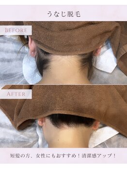 メンズラボ 京都山科店/【うなじ脱毛ビフォーアフター】