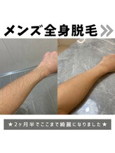 ユニクリア(Uni clear)/メンズ全身脱毛コース