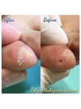 巻き爪補正店 札幌店/ 【副爪ケア】