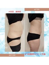 縁(en)/脂肪冷却2回